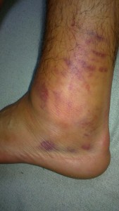 Kotník Petra Dohnala po čistém zákroku